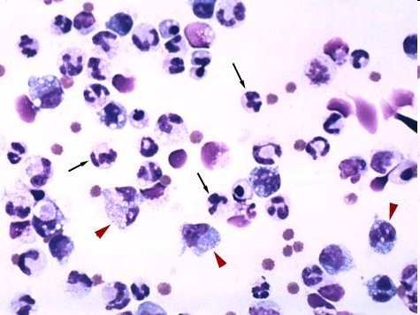 Free abdominal fluid sample from a dog with pancreatitis showing large numbers of neutrophils, many of which have vacuolated cytoplasm.